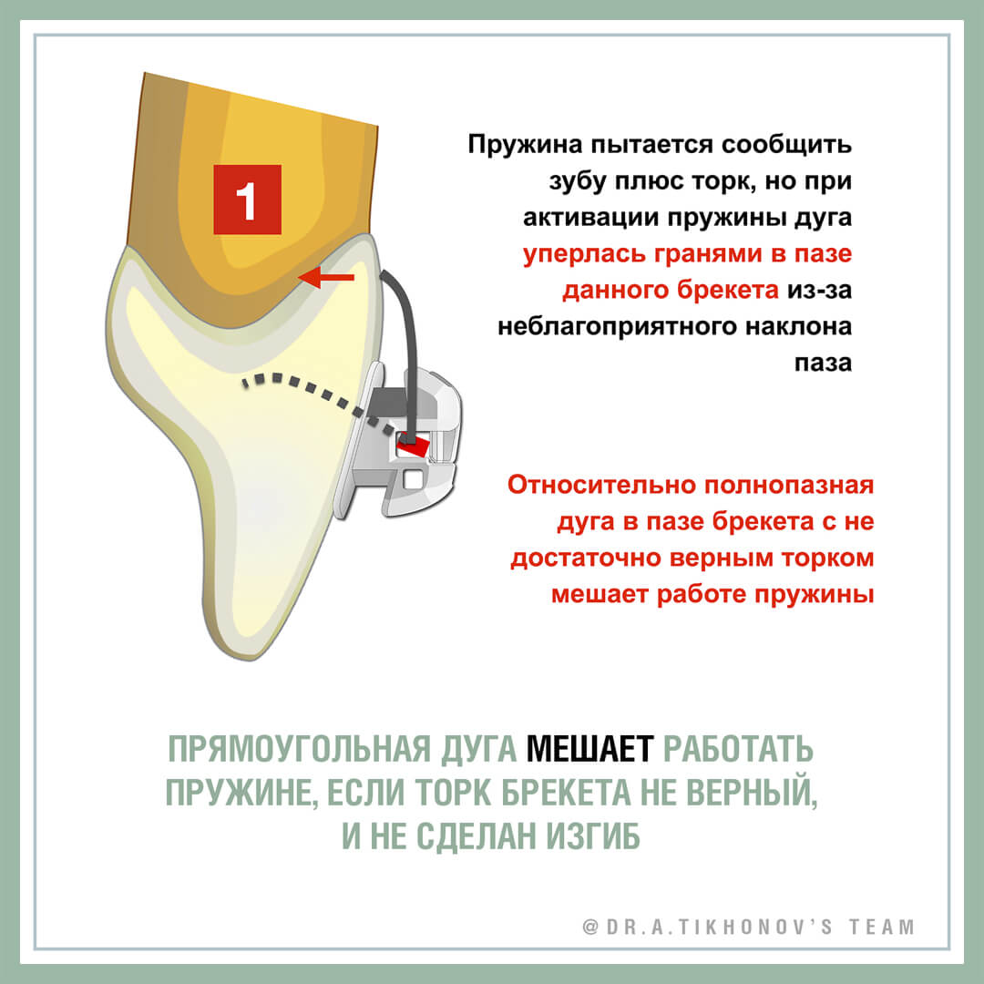 Туманные вопросы ортодонтии. Работают ли торковые пружины? - интересно об  ортодонтии, имплантации и протезировании зубов